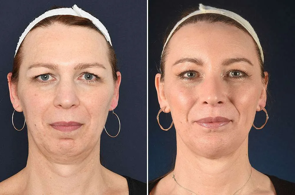 Retinlift